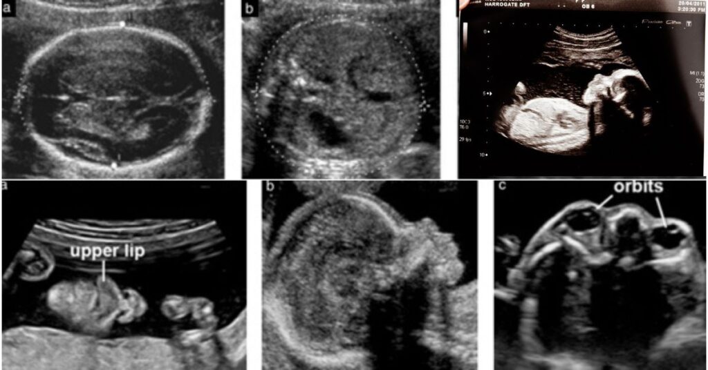 A Detailed Guide to Congenital or Fetal Anomaly Scan 2024